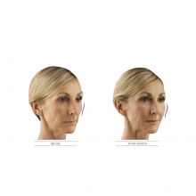 JUVÉDERM Voluma® XC