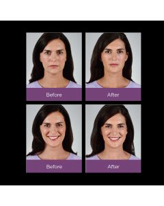 JUVÉDERM VOLLURE™ XC Before and After