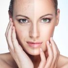 Collagen Induction Microchaneling