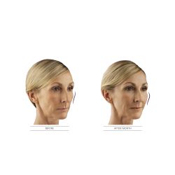 JUVÉDERM Voluma® XC