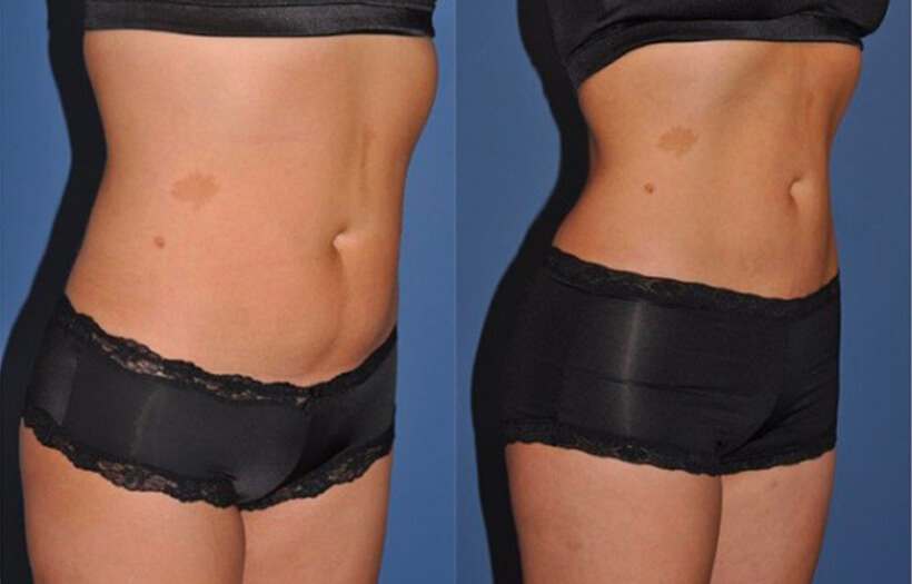 Liposuction