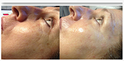 microneedling